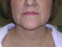 chin liposuction picture - after photo