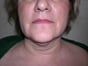 chin liposuction picture - before photo