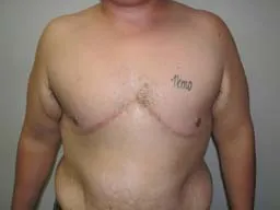 After- breast reconstructive surgery follow-ups - FTM Mastectomy