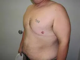 After- breast reconstructive surgery follow-ups - FTM Mastectomy
