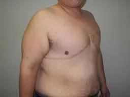 After- breast reconstructive surgery follow-ups - FTM Mastectomy