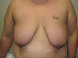 Before - breast reconstructive surgery - FTM Mastectomy