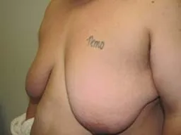 Before - breast reconstructive surgery - FTM Mastectomy