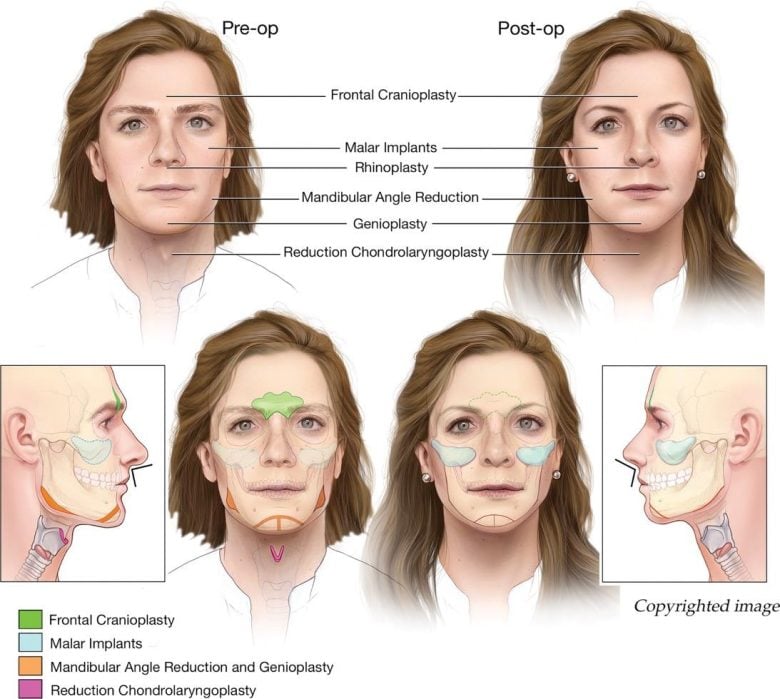 Side-by-side comparison of facial feminization surgery results